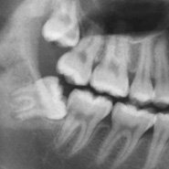 An x-ray of a wisdom tooth