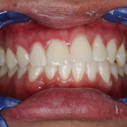Photo of teeth after whitening