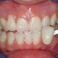 Photo 2 of teeth after whitening